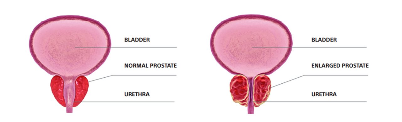 Comparison image between a normal and enlarged prostate